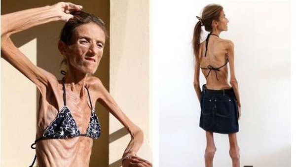 Ini Penyakit dan Gejala Valeria Leviti yang Meninggal karena Anoreksia